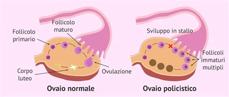 Schema che mostra l'ovaio policistico