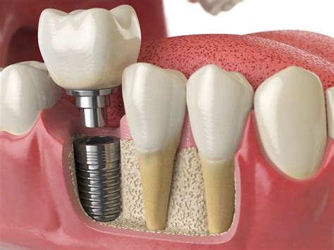 Impianto dentale integrato nell'osso
