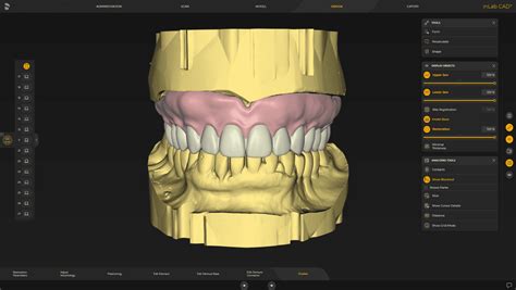 Progettazione digitale dell'impianto dentale