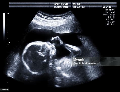 Baby sucking thumb in utero ultrasound