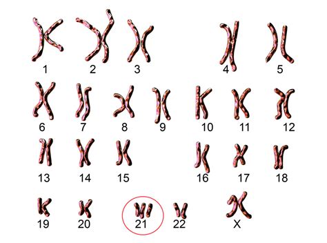 Schema della struttura del cromosoma 21 e la sua triplicazione nella Sindrome di Down
