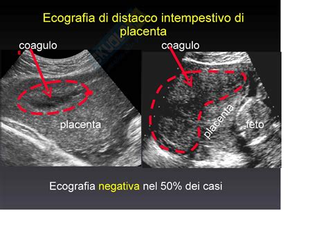 Distacco prematuro di placenta schema