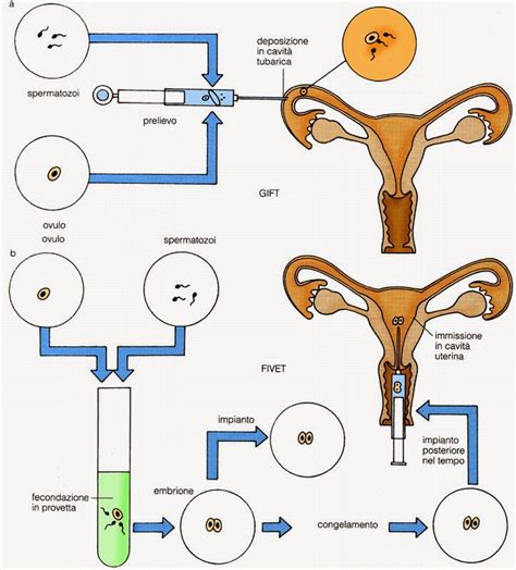 Diagramma della fecondazione eterologa