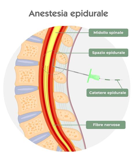Posizionamento paziente per anestesia lombare e catetere epidurale