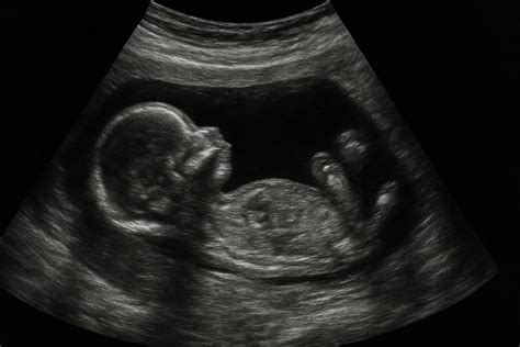 Prenatal ultrasound image
