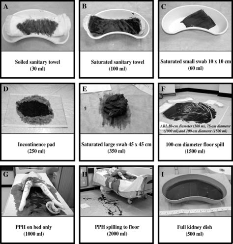 Grafico che mostra la riduzione delle perdite ematiche e delle trasfusioni grazie alle tecniche interventistiche