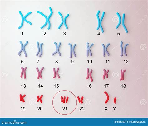 Kariotipo umano con evidenza della Trisomia 21