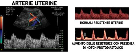 Flussimetria Doppler delle arterie uterine alterate con alto indice di pulsatilità