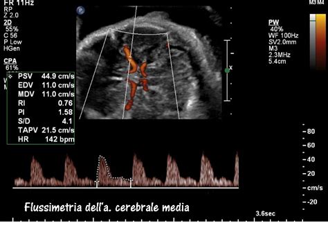 Flussimetria Doppler dell'arteria cerebrale media ridistribuita con flusso diastolico aumentato
