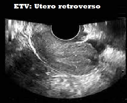 Schema anatomico dell'utero in posizione antiverso e retroverso