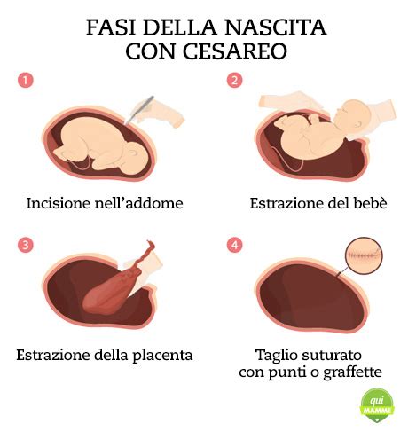 Fasi del parto cesareo