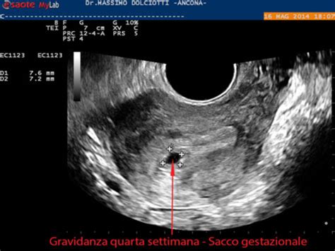 Rappresentazione ecografica di un sacco gestazionale