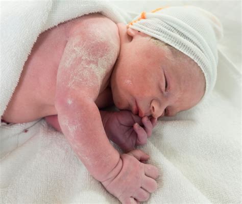 vernice caseosa sulla pelle del neonato