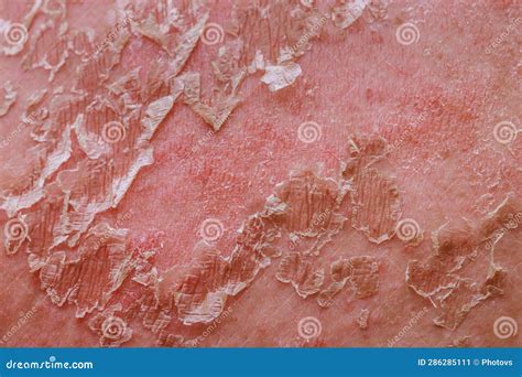 Pelle delicata di neonato irritata