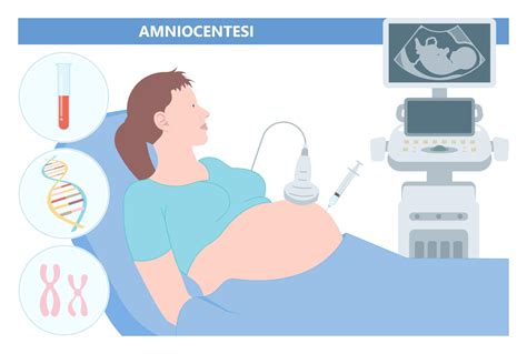 Schema della procedura di villocentesi