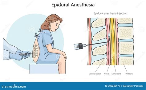 Schema anatomico dell'iniezione epidurale