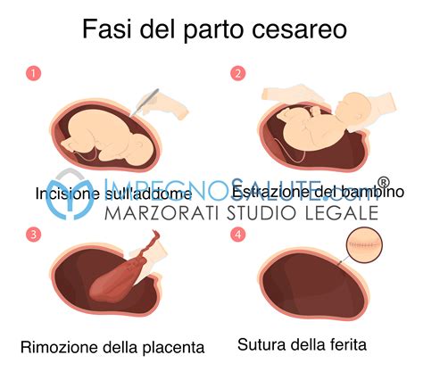 Illustrazione di un parto cesareo