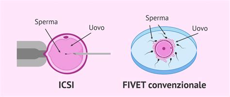 Differenze tra FIVET convenzionale e ICSI