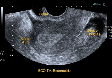 Ecografia di un utero con endometrio trilaminare