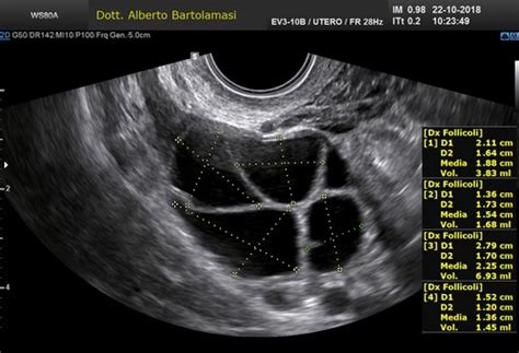 illustrazione schematica dell'utero in gravidanza e del monitoraggio ecografico