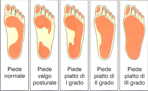 grafico di confronto tra piede sano e piede piatto
