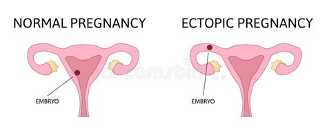 Diagramma di una gravidanza ectopica