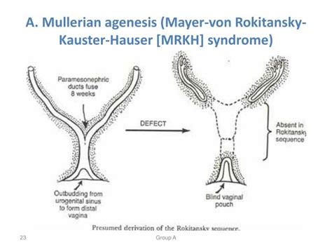Sindromedi Mayer Rokitansky Kuster Hauser