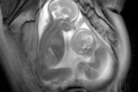 Coppia che scopre di aspettare gemelli tramite ecografia