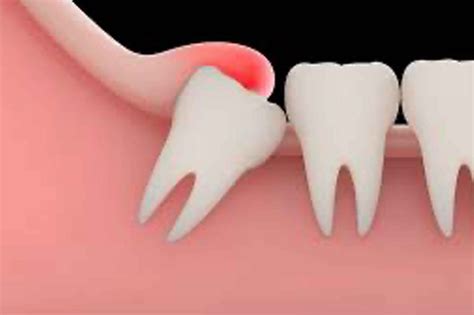Illustrazione del dente del giudizio parzialmente erotto con infiammazione pericoronale