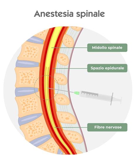 Tipi di Anestesia Regionale (Epidurale, Spinale)