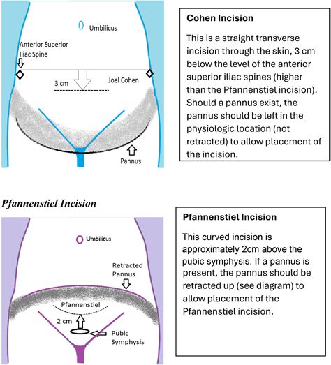 Incisioni Cesareo (Pfannenstiel vs Stark)