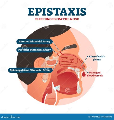 Illustrazione di epistassi