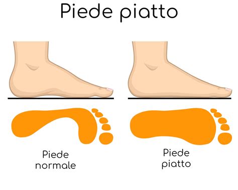 Bambino con piede piatto