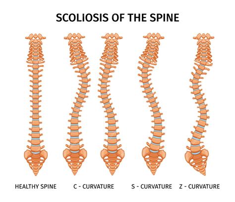 Schema di scoliosi e colonna vertebrale
