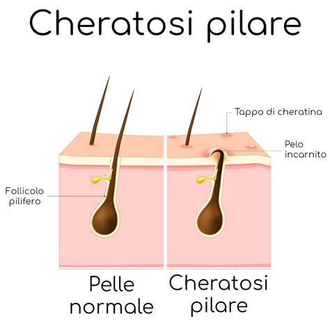 rappresentazione macroscopica della pelle con cheratosi pilare