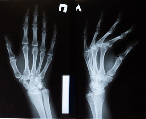 Radiografia della mano per la determinazione dell'età ossea