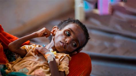 Bambini affetti da malnutrizione acuta