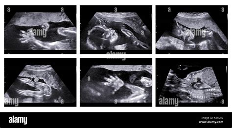 Ecografia che mostra i genitali di un feto