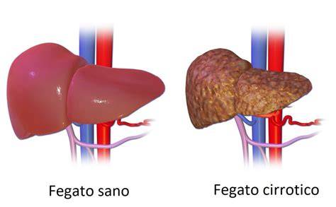 Diagramma di un fegato sano e un fegato affetto da steatosi epatica