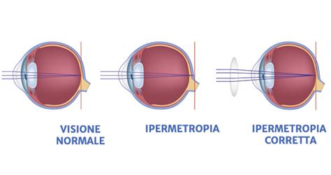 confronto tra occhio normale e occhio ipermetrope nel bambino