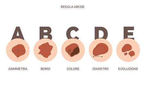 infografica esplicativa della regola ABCDE per il controllo dei nei