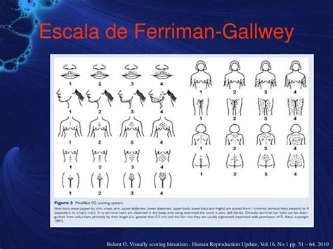diagramma della scala di Ferriman-Gallwey con le zone valutate
