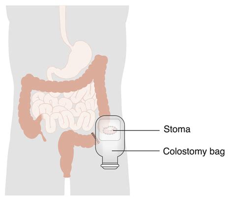 Schema di diversione urinaria con stoma