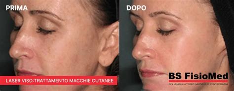 Risultati del trattamento laser sulle strie albae