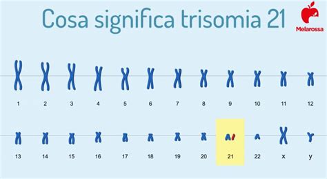 Schema che illustra i tre tipi di sindrome di Down: Trisomia 21, Mosaicismo e Traslocazione