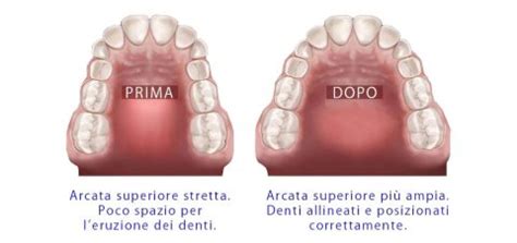 illustrazione anatomica del palato stretto e del suo corretto sviluppo