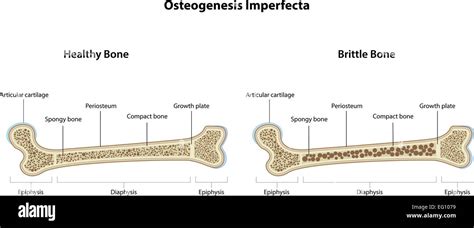 Illustrazione sull'osteogenesi imperfetta