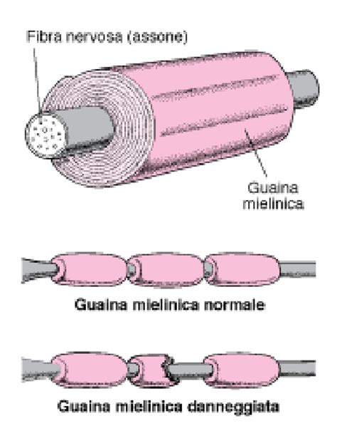 Meccanismo di danneggiamento della mielina nella sindrome di Guillain-Barré