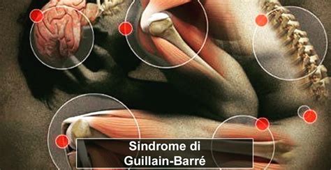 Prognosi della sindrome di Guillain-Barré e fattori di recupero