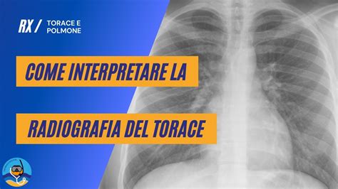 Radiografia del torace con aspetto a vetro smerigliato nella RDS